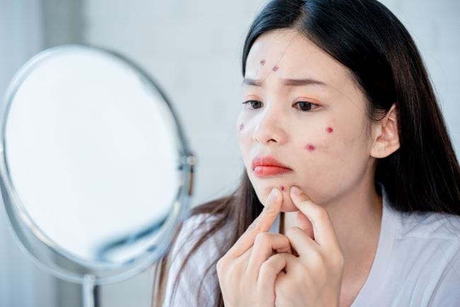 Acne Vulgaris, Kenali Penyebab dan Langkah Penanganannya - Alodokter