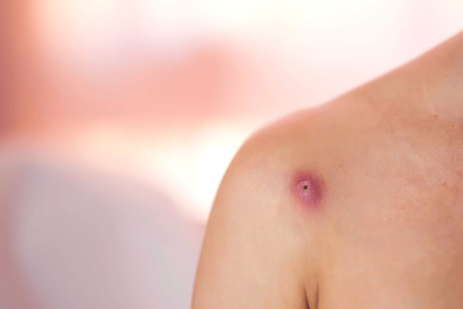 Cara Mengatasi Bisul yang Perlu Anda Ketahui - Alodokter