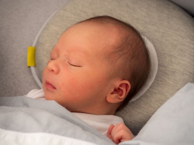 Ketahui Sampai Umur Berapa Kepala Peyang Bisa Diperbaiki dan Cara Mengatasinya - Alodokter