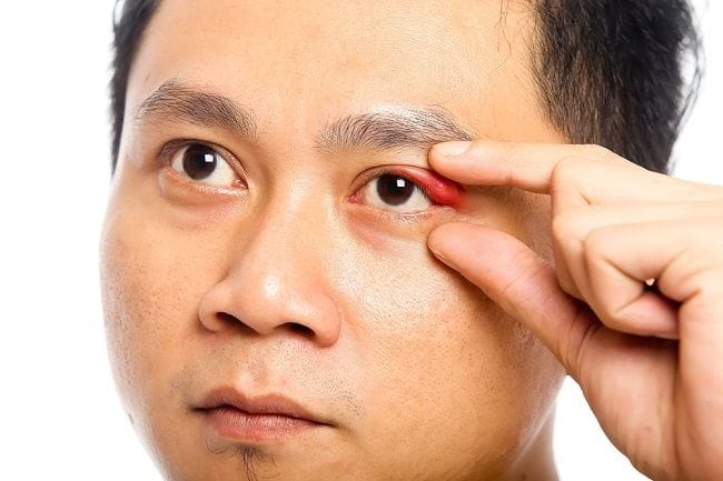 8 Cara Menghilangkan Mata Bintitan dalam Sehari - Alodokter