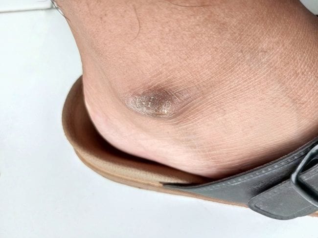 Mata Kaki Hitam, Ketahui Penyebab dan Cara Mengatasinya - Alodokter