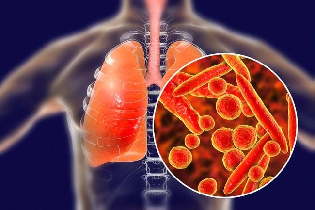 Bakteri Mycoplasma pneumoniae, Ketahui Penularan sampai Cara Mencegahnya - Alodokter