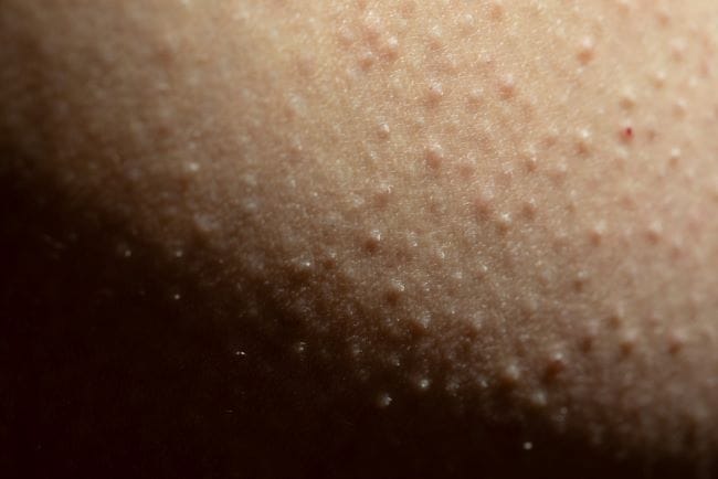 5 Cara Menghilangkan Kulit Ayam di Wajah secara Alami dan Medis - Alodokter