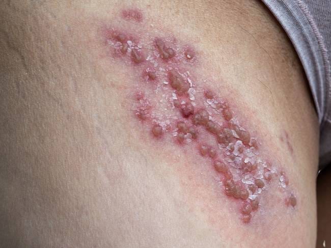 6 Obat Herpes Genital Paling Manjur Beserta Harganya - Alodokter