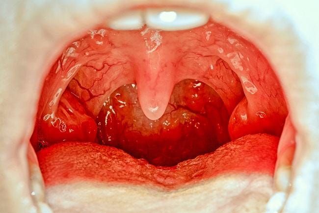 Benjolan di Langit-langit Mulut, Ketahui Penyebab dan Penanganannya - Alodokter