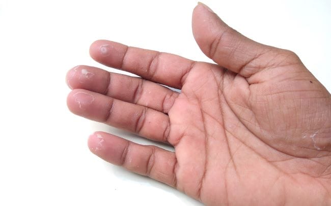 Kulit Jari Tangan Mengelupas, Inilah Penyebab dan Cara Mencegahnya - Alodokter