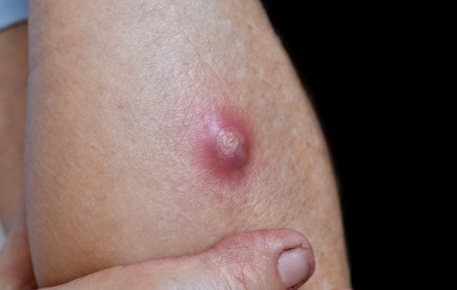 8 Cara Mengobati Bisul agar Cepat Kempes - Alodokter