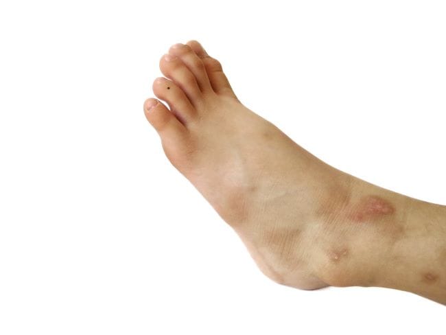 12 Cara Menghilangkan Bekas Luka di Kaki yang Ampuh - Alodokter