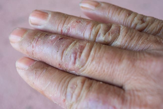 Kutu Air di Jari Tangan, Ketahui Penyebab dan Cara Mengatasinya - Alodokter