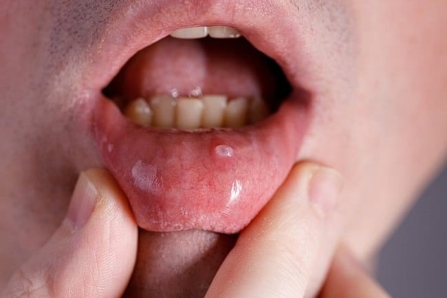 Kista Mulut, Ini Penyebab, Gejala, dan Penanganannya - Alodokter