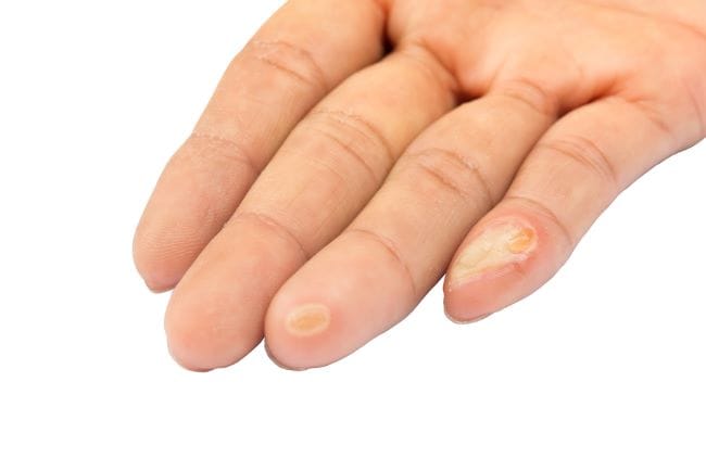 Mata Ikan di Jari Tangan, Ketahui Penyebab dan Cara Menghilangkannya - Alodokter