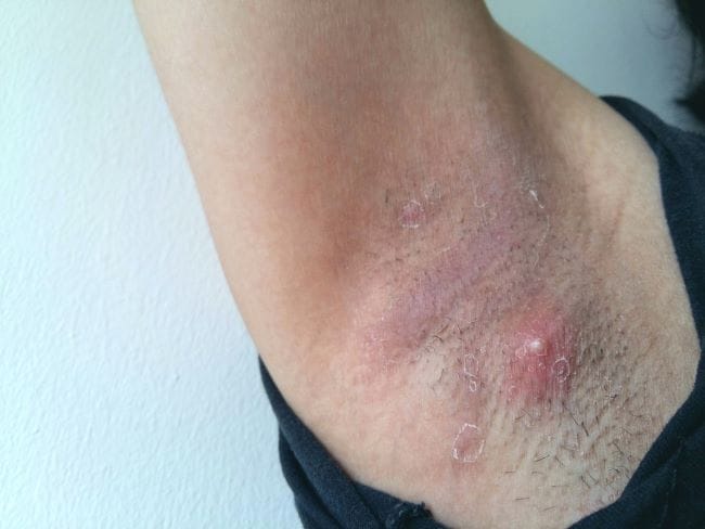 Benjolan di Ketiak Sakit bila Ditekan, Inilah Penyebab dan Cara Mencegahnya - Alodokter