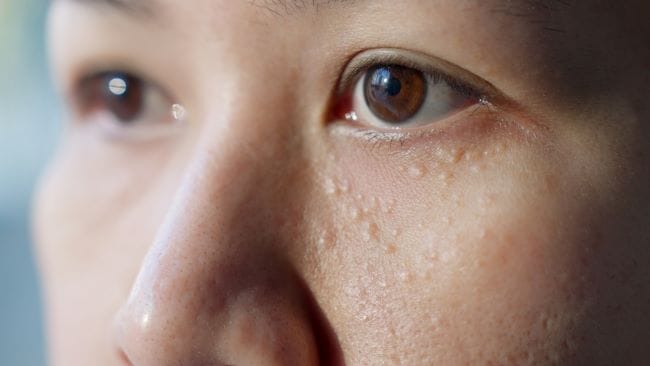 Wajah Tiba-Tiba Beruntusan dan Gatal, Ini Penyebab dan Cara Mengatasinya - Alodokter