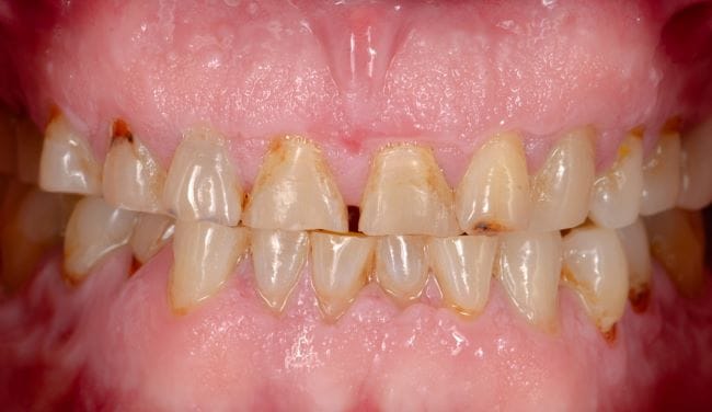 Penyebab Gigi Keropos dan Cara Mencegahnya - Alodokter