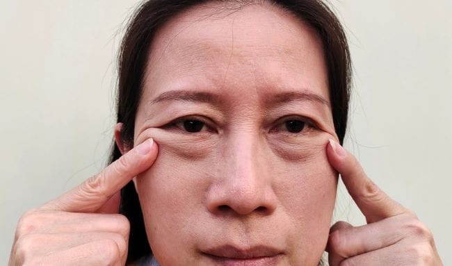 Kantung Mata Kendur, Inilah Penyebab dan Cara Mencegahnya - Alodokter