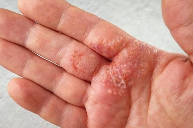 7 Obat Kutu Air di Tangan yang Ampuh dan Mudah Didapatkan - Alodokter