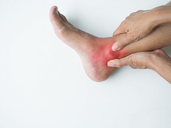 Tarsal Tunnel Syndrome