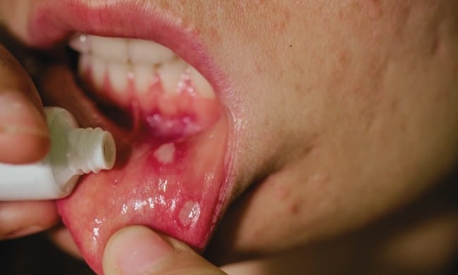 Triamcinolone Salep Mulut