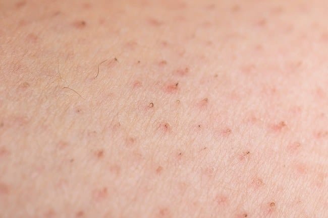 Rambut Tumbuh ke Dalam