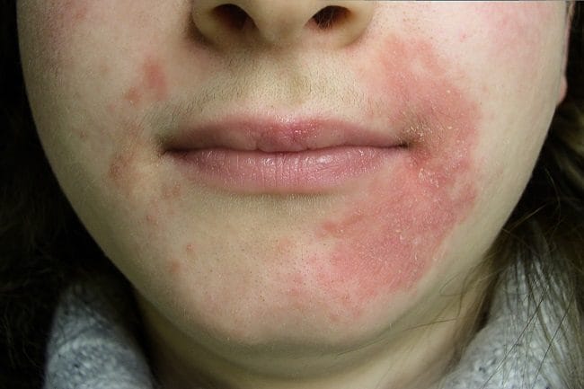 Dermatitis Perioral