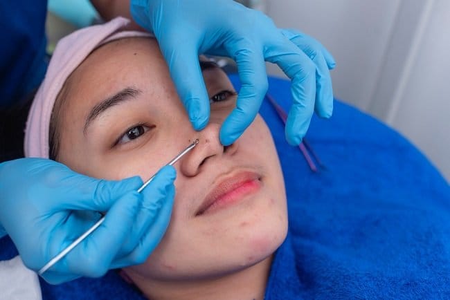 5 Cara Menghilangkan Komedo Paling Ampuh dan Aman - Alodokter