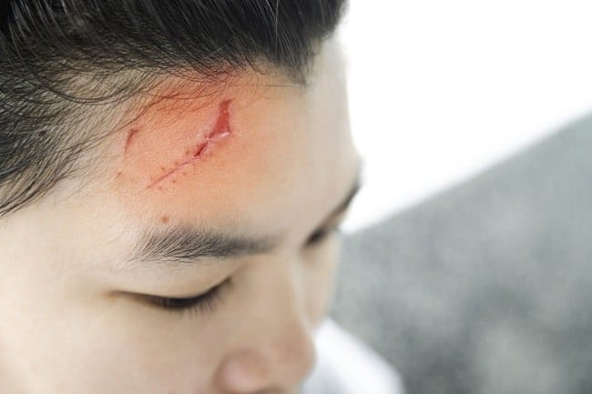 Bagian Kepala yang Berbahaya Jika Terbentur, Ini Penjelasannya - Alodokter