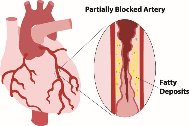 Serangan Jantung Ringan