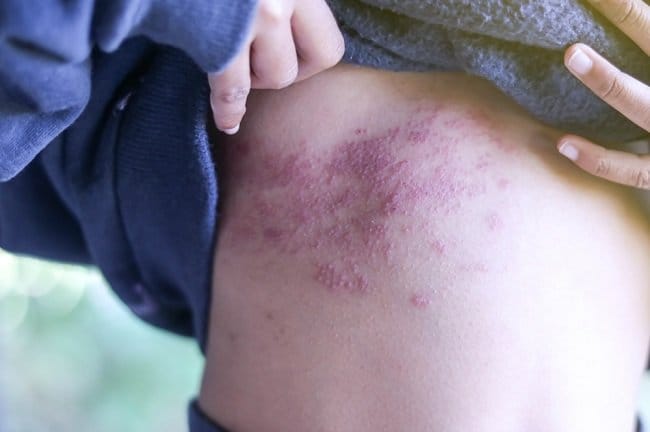 7 Pantangan Cacar Ular yang Dapat Memperlambat Penyembuhan - Alodokter