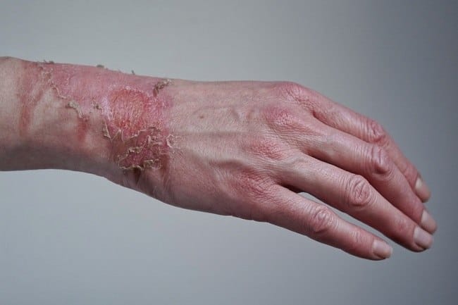 Luka Bakar Derajat 3, Ketahui Cara Menangani dan Komplikasi yang Bisa Terjadi - Alodokter