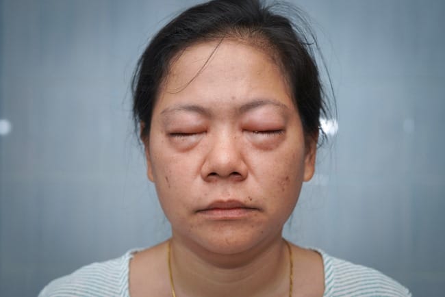 6 Obat Sakit Mata Bengkak yang Ampuh dan Efektif - Alodokter