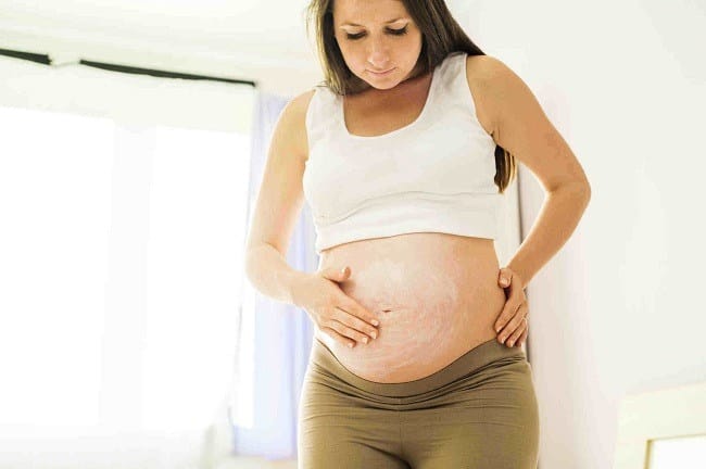 Ketahui Penyebab Stretch Mark dan Cara Mencegahnya - Alodokter