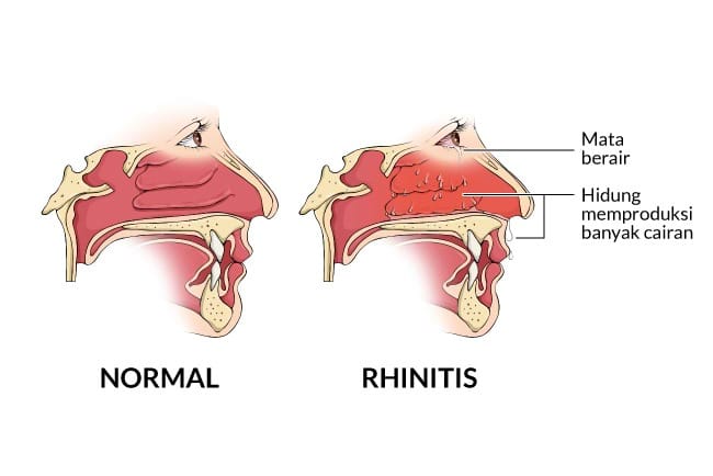 Rhinitis