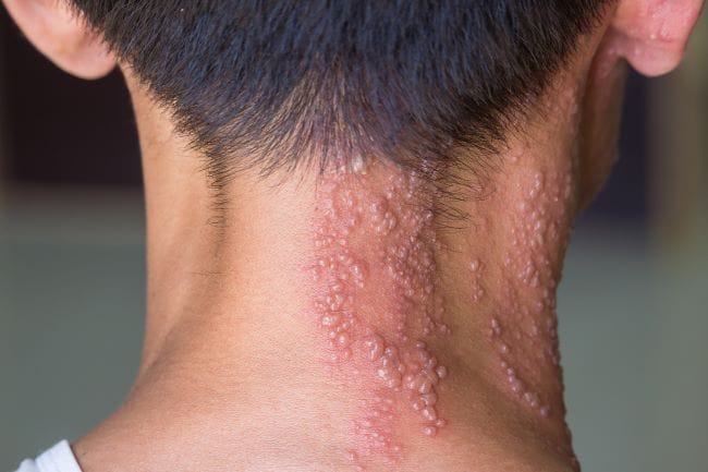 Herpes di Leher, Kenali Penyebab dan Cara Mengatasinya - Alodokter
