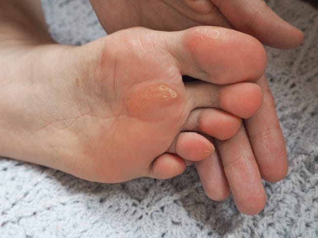 5 Cara Menghilangkan Kapalan di Kaki yang Efektif - Alodokter