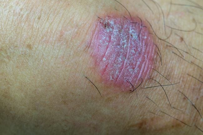 5 Obat Kurap Alami yang Ampuh dan Aman - Alodokter