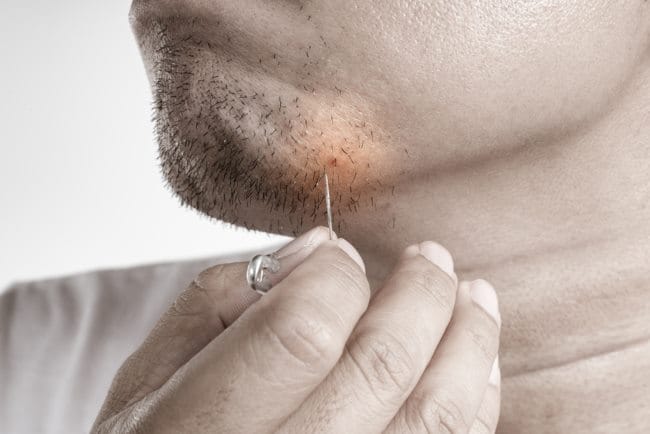 Ingrown Hair, Kenali Gejala dan Cara Mengatasinya - Alodokter