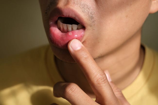 6 Obat Herbal Sariawan yang Ampuh di Apotek - Alodokter