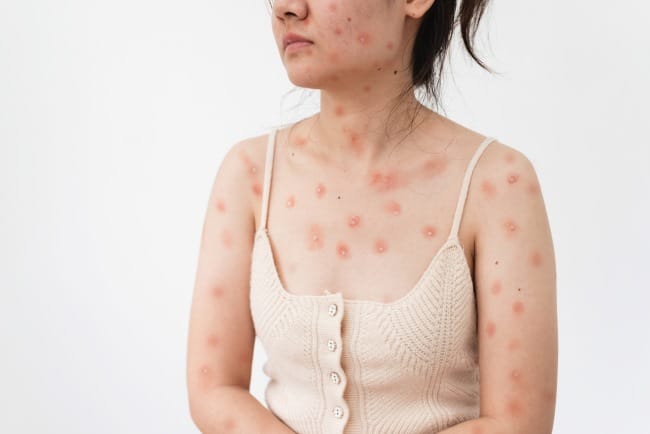 Kasus Cacar Monyet Menjadi Perhatian, Lakukan Cara Ini untuk Mencegahnya - Alodokter