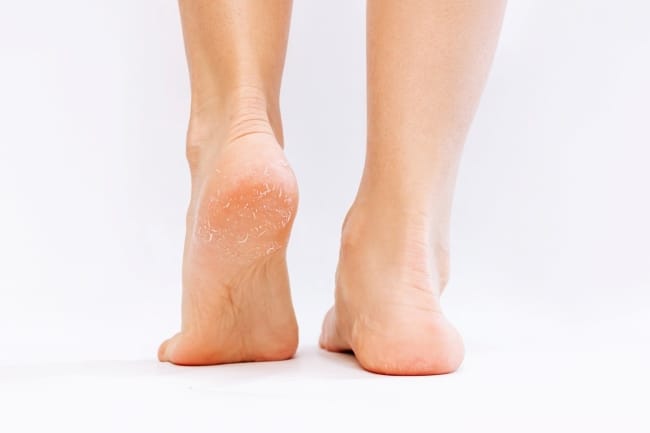 7 Penyebab Kaki Pecah-Pecah dan Cara Mencegahnya - Alodokter
