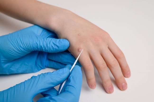 Kutil di Tangan, Inilah Penyebab dan Cara Mengatasinya - Alodokter