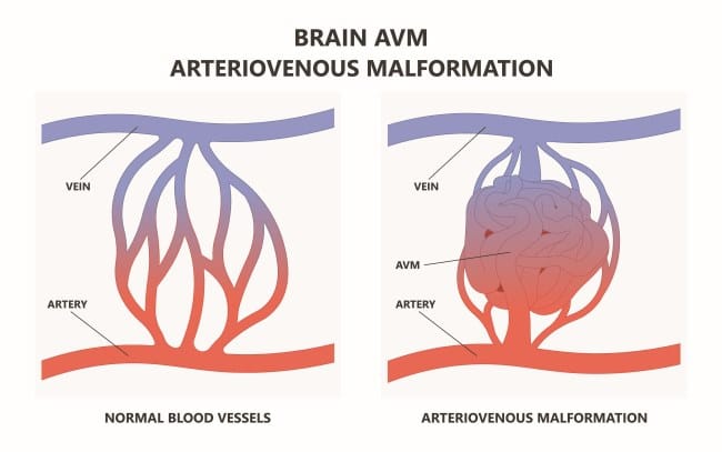 Malformasi Arteri Vena