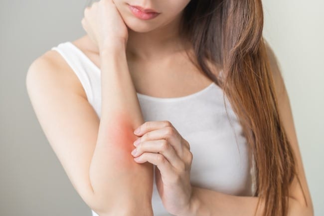 6 Obat Herbal Gatal pada Kulit yang Paling Ampuh di Apotek - Alodokter