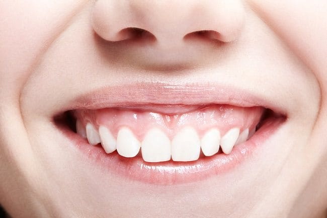 Gummy Smile, Ketahui Penyebab dan Cara Mengatasinya - Alodokter