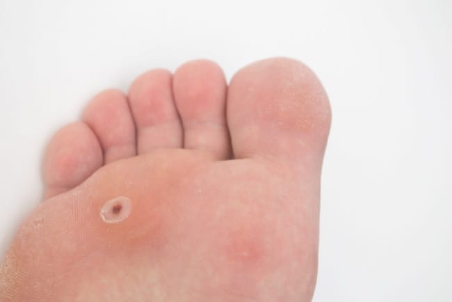 8 Cara Menghilangkan Kutil di Kaki yang Ampuh - Alodokter