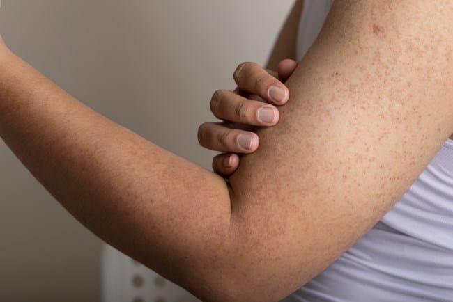 Keratosis Pilaris, Kenali Penyebab dan Penanganannya - Alodokter