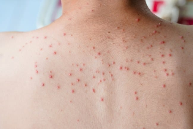 6 Sabun Jerawat Punggung yang Ampuh Atasi Keluhan - Alodokter