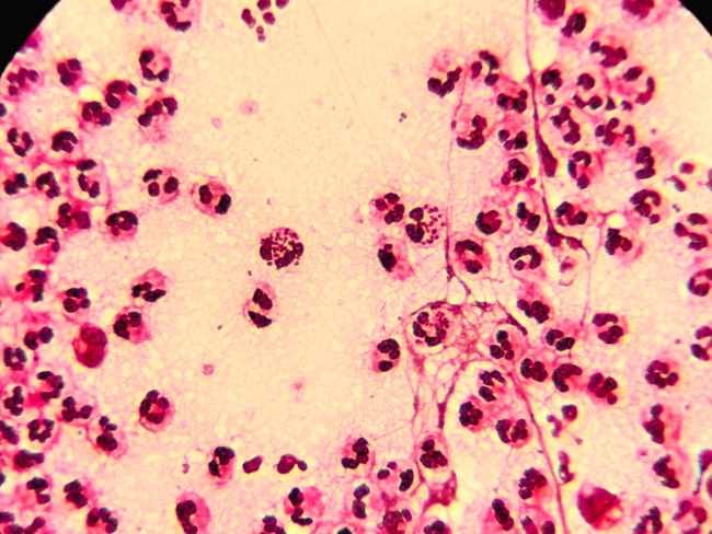 Neisseria gonorrhoeae, Bakteri Penyebab Gonore yang Patut Diwaspadai - Alodokter