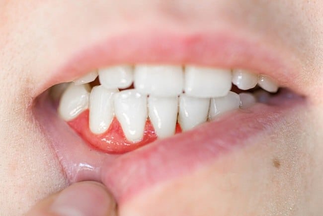 Gusi Turun, Ini Penyebab dan Cara Mengobatinya - Alodokter