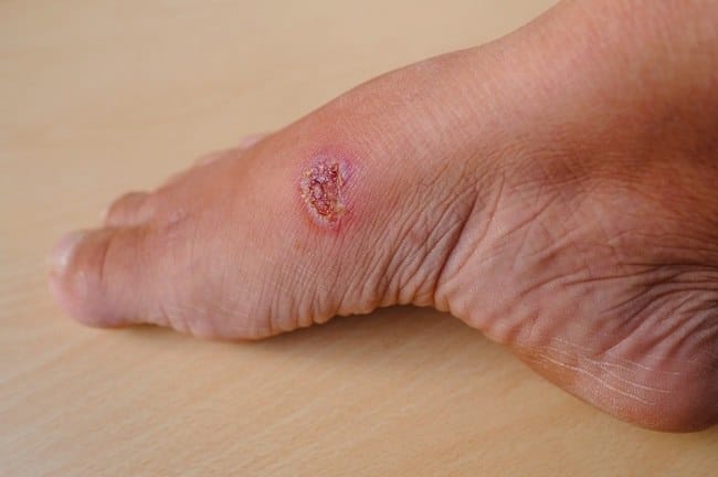 Koreng Bernanah, Ketahui Penyebab dan Cara Mengobatinya - Alodokter