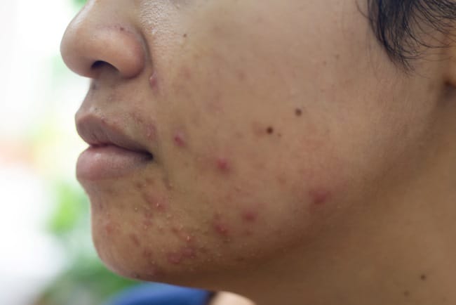 Jerawat Mendem, Ini Penyebab, Cara Mengatasi, dan Pencegahannya - Alodokter